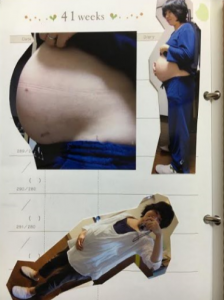 chocoさん妊婦画像（手術痕あり）