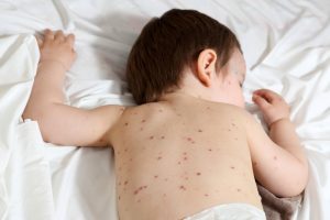 Details of a baby aged 20 months old, he has chickenpox.