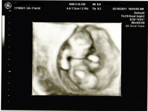 妊娠11週目の3D/4Dエコー画像（写真）