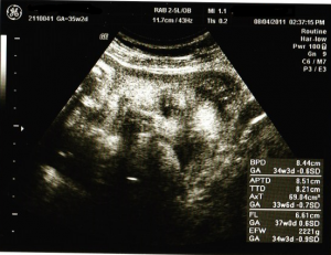 妊娠35週目の2Dエコー画像（写真）