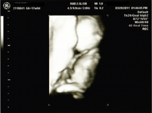 妊娠17週目の3D/4Dエコー画像（写真）