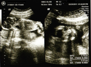 妊娠17週目の2Dエコー画像（写真）